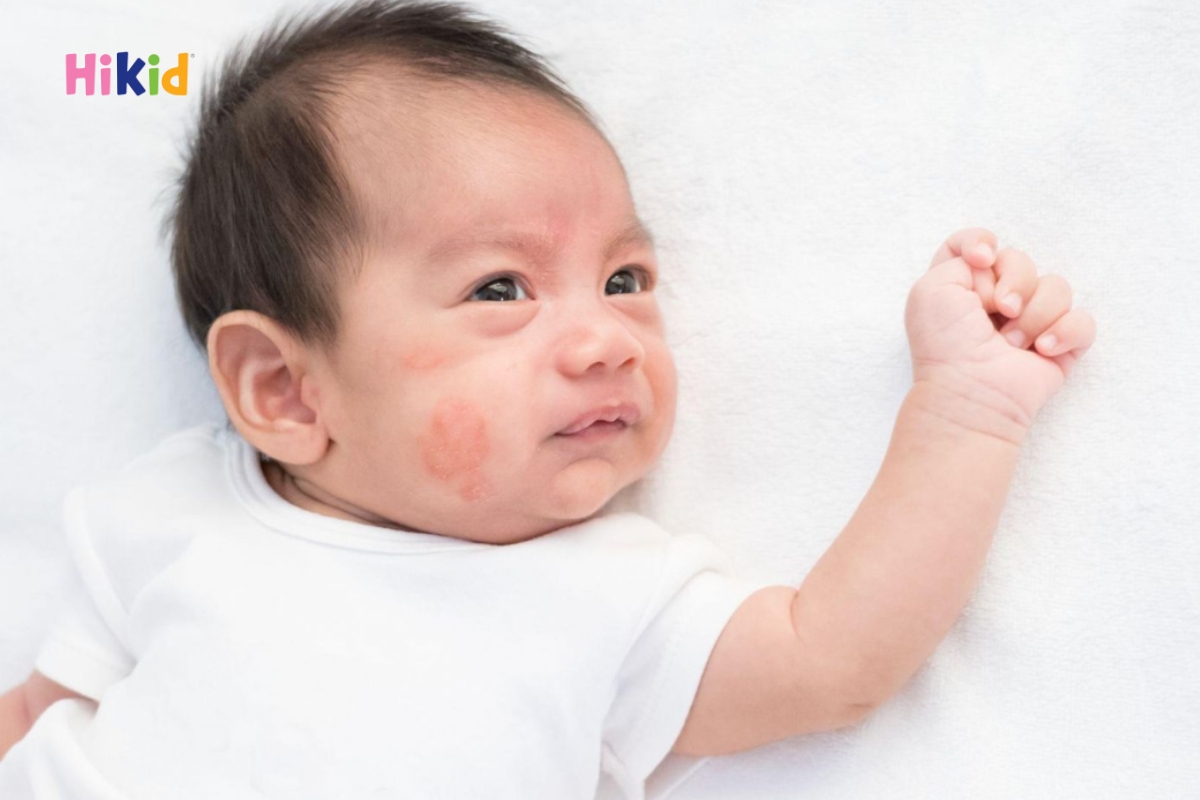 Dị ứng đạm sữa bò là phản ứng miễn dịch phổ biến ở trẻ nhỏ