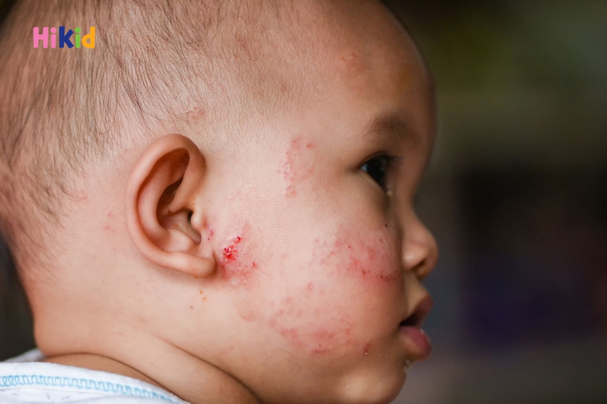 Dấu hiệu bé dị ứng đạm bò